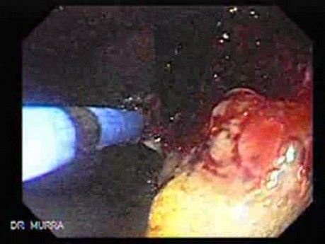 Recurrent Gastric Cancer after Gastrectomy Billroth II (5 of 6)
