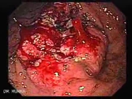 Adenocarcinoma of the Antrum (4 of 5)