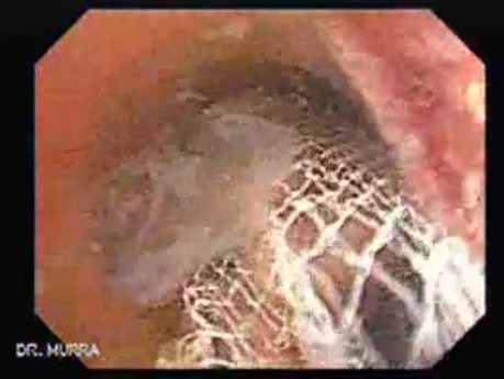 Colonoscopic Polypectomy (18 of 29)