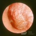 Severe Acute Otitis Media Left Ear