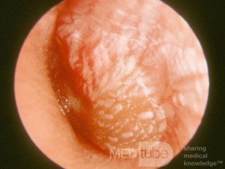 Severe Acute Otitis Media Left Ear