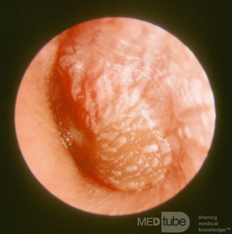 Severe Acute Otitis Media Left Ear