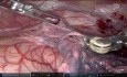 Robotic Thymectomy for Myasthenia Gravis