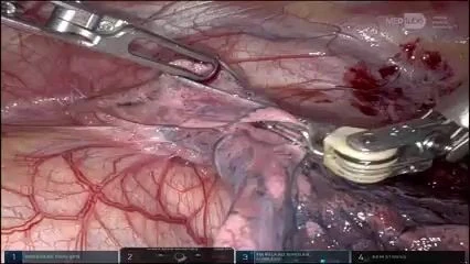 Robotic Thymectomy for Myasthenia Gravis