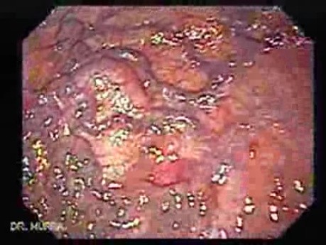 Linear Gastric Varices (3 of 3)