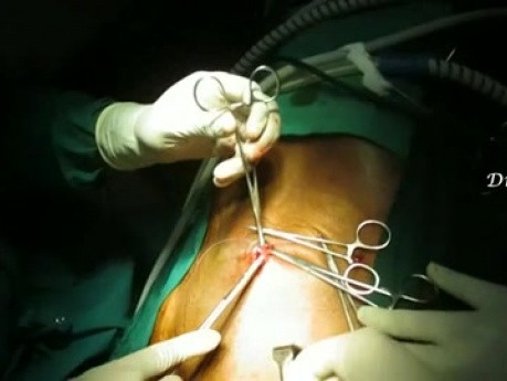 Single Incision Laparoscopic TEP / SILS TEP