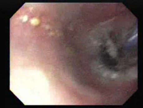 Achalasia - Insertion of the Balloon