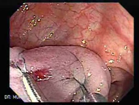 Colonoscopic Polypectomy (14 of 23)