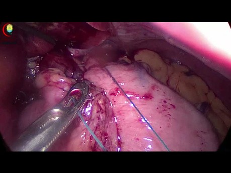 Fundoplication Total