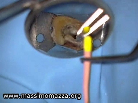 Value Of Microscopy In Endodontics