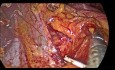 Gastric Volvulus, Laparoscopic Treatment