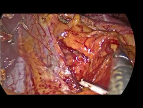 Gastric Volvulus, Laparoscopic Treatment
