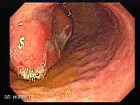 Gastrointestinal Stromal Tumor - GIST (5 of 13)