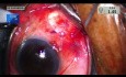 Glaucoma Shunt with Steroid injection for Uveitis