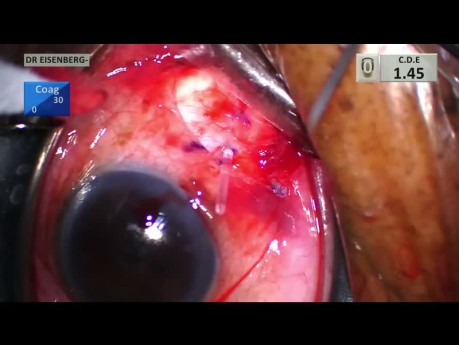 Glaucoma Shunt with Steroid injection for Uveitis