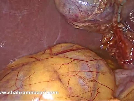 Cystic Duct Draining Into the Right Hepatic Duct