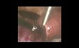 Laparoscopic Excision Of A Pedunculated Fibroid Using Bipolar