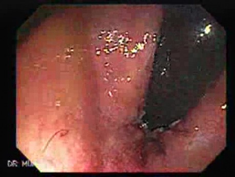 Status Post Rubber Band Treatment for Internal Hemorrhoids (3 of 3)