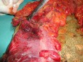 Multiple Rectal Ulcers (76 of 110)