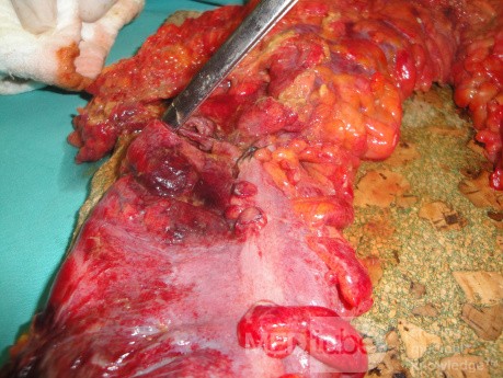 Multiple Rectal Ulcers (76 of 110)