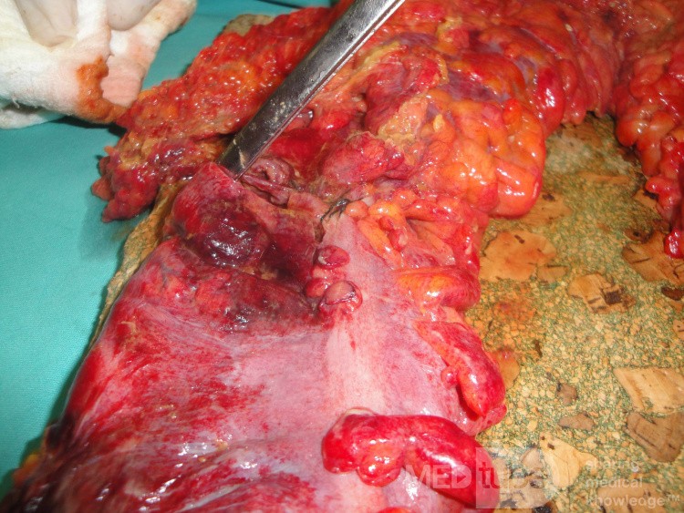 Multiple Rectal Ulcers (76 of 110)