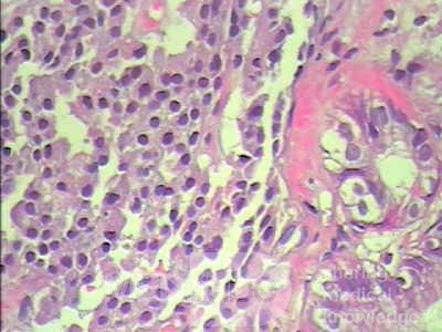 Gastric Carcinoid tumor (8 of 8)