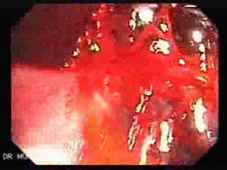 Severe Bleeding after Biopsies (5 of 7) - Hemoclip