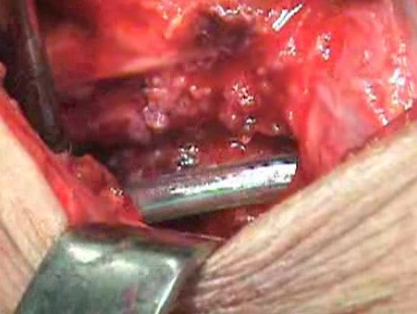 Perforation of a Esophageal Carcinoma After the Procedure with Hydrostatic Balloon Dilation -  Visualization of the Perforation