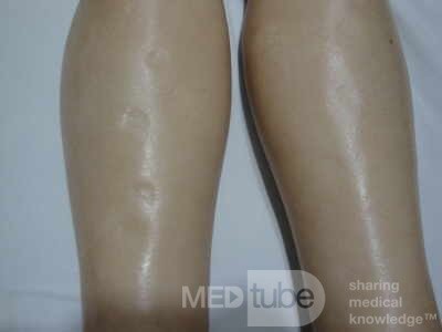 Multiple Rectal Ulcers (30 of 110)
