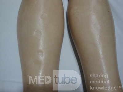 Multiple Rectal Ulcers (30 of 110)