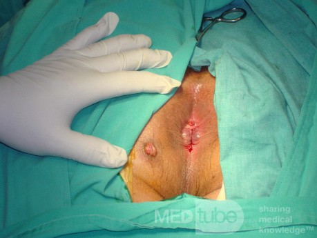 Fistula in Ano (4 of 7)