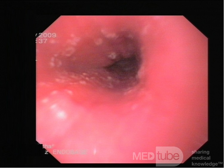 First Stage Of Esophageal Candidiasis