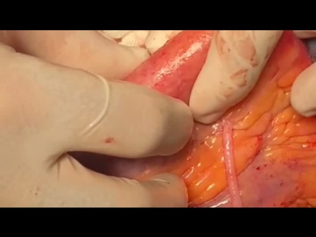LV Aneurysm Repair and Size Reduction with Zeraatiannejaddavani's Technique and Without LV Opening