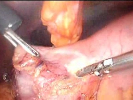 Gastrointestinal Stromal Tumor - GIST (22 of 65)