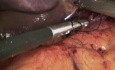 Morbid Obesity and Hiatal Hernia Synchronous Laparoscopic Treatment