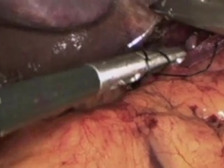 Morbid Obesity and Hiatal Hernia Synchronous Laparoscopic Treatment