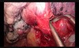 Uniportal VATS Anatomic Left Upper Trisegmentectomy