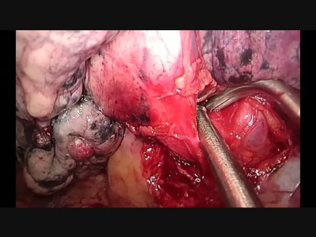 Uniportal VATS Anatomic Left Upper Trisegmentectomy