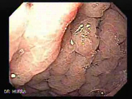 Eosinophilic Gastritis (1 of 2)