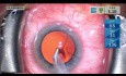Cataract Surgery with Glaucoma Microstent - Uncut Teaching Edition