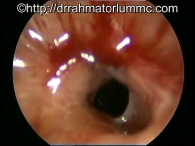 Subglottic Ulcers with Cricotracheal Stenosis - Infection