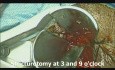 Stapled Trans Anal Resection of Rectal Stricture (STARR)