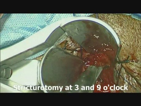Stapled Trans Anal Resection of Rectal Stricture (STARR)