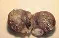 Plastic Linitis with bilateral Krukenberg´s tumor (6 of 13)