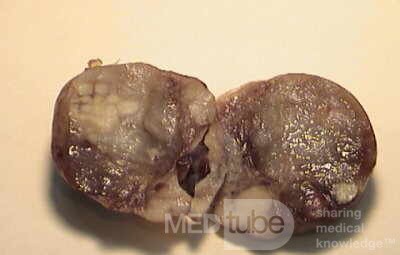Plastic Linitis with bilateral Krukenberg´s tumor (6 of 13)