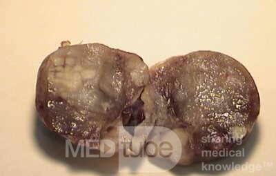 Plastic Linitis with bilateral Krukenberg´s tumor (6 of 13)