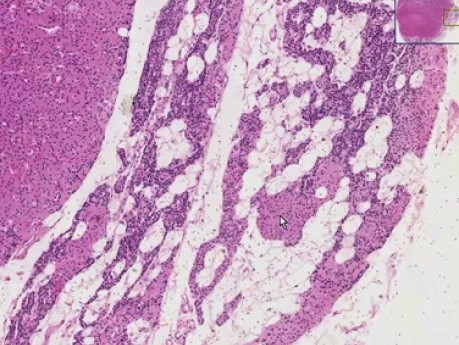Oxyphil adenoma - Histopathology of parathyroid