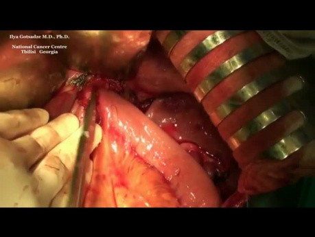 Roux-en-Y reservoir after Gastrectomy