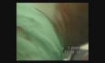 Lung Cancer Surgery