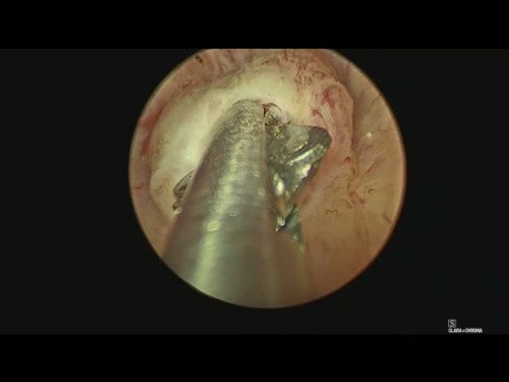 Stones in Ejaculatory Ducts